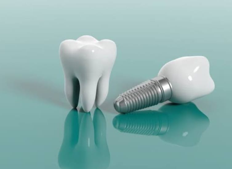 Dental Implant /ડેન્ટલ ઇમ્પ્લાન્ટ