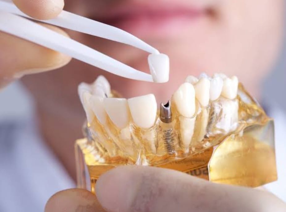 How to take care of your Implant તમારા ઇમપ્લાન્ટ ની જાણવણી કંઈ રીતે કરશો?