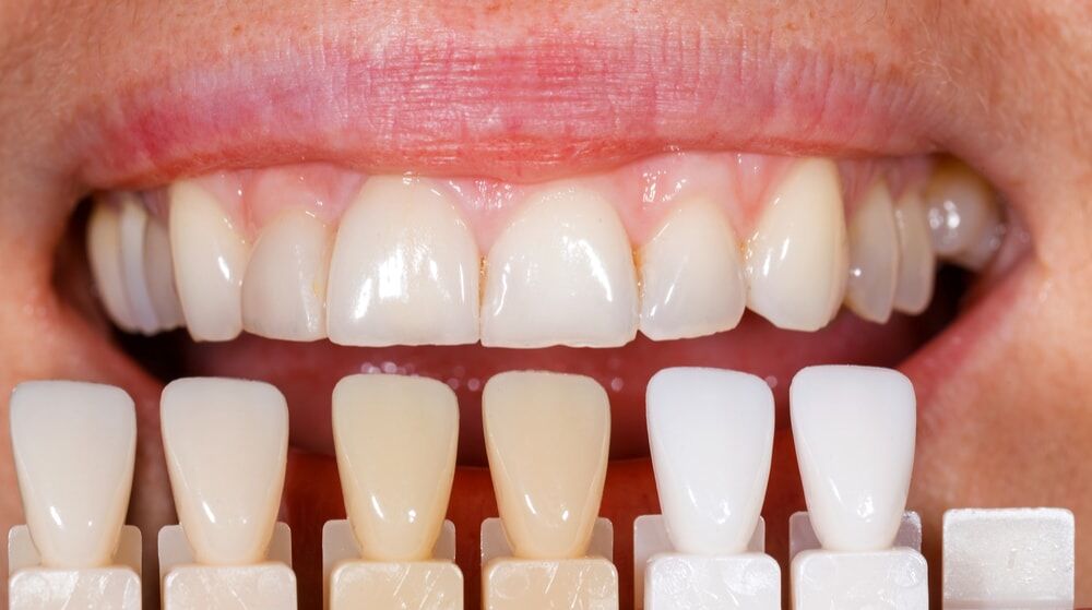 TEETH BLEECHING /TEETH WHITENING  દાંત બ્લીચિંગ/દાંત સફેદ થવું