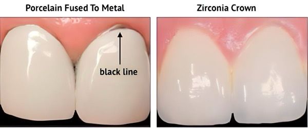 Dental Crown & Bridge