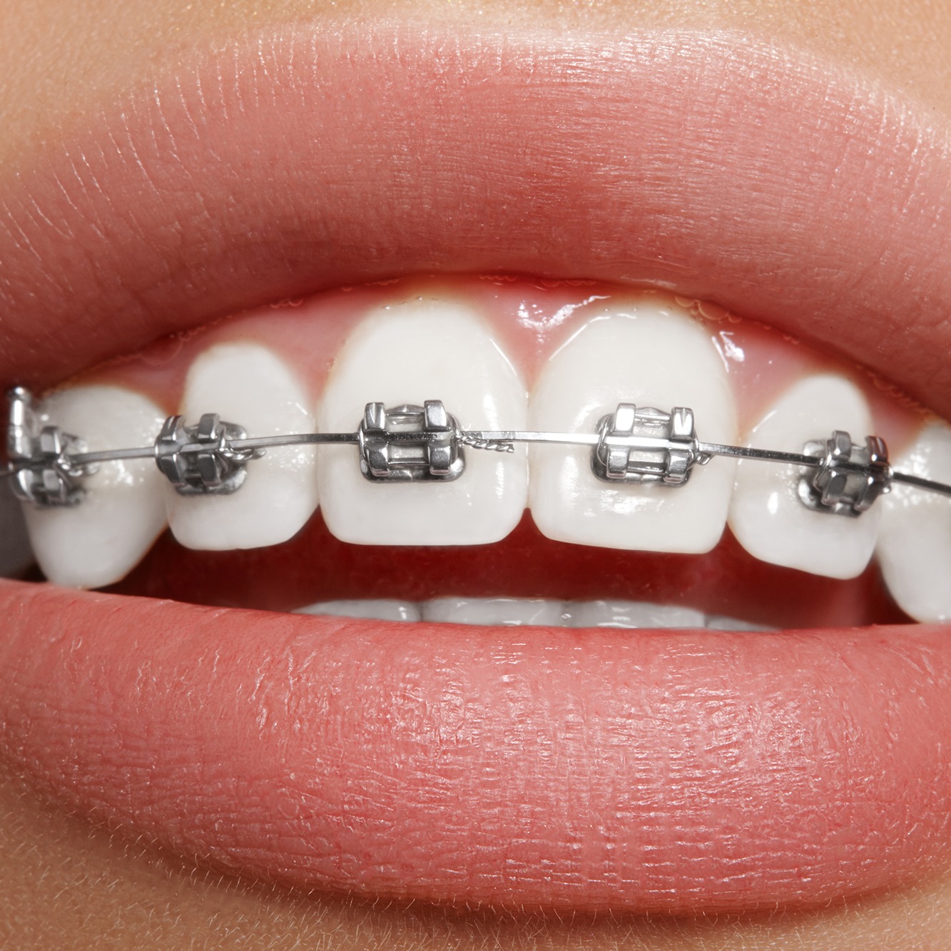 Braces Treatment