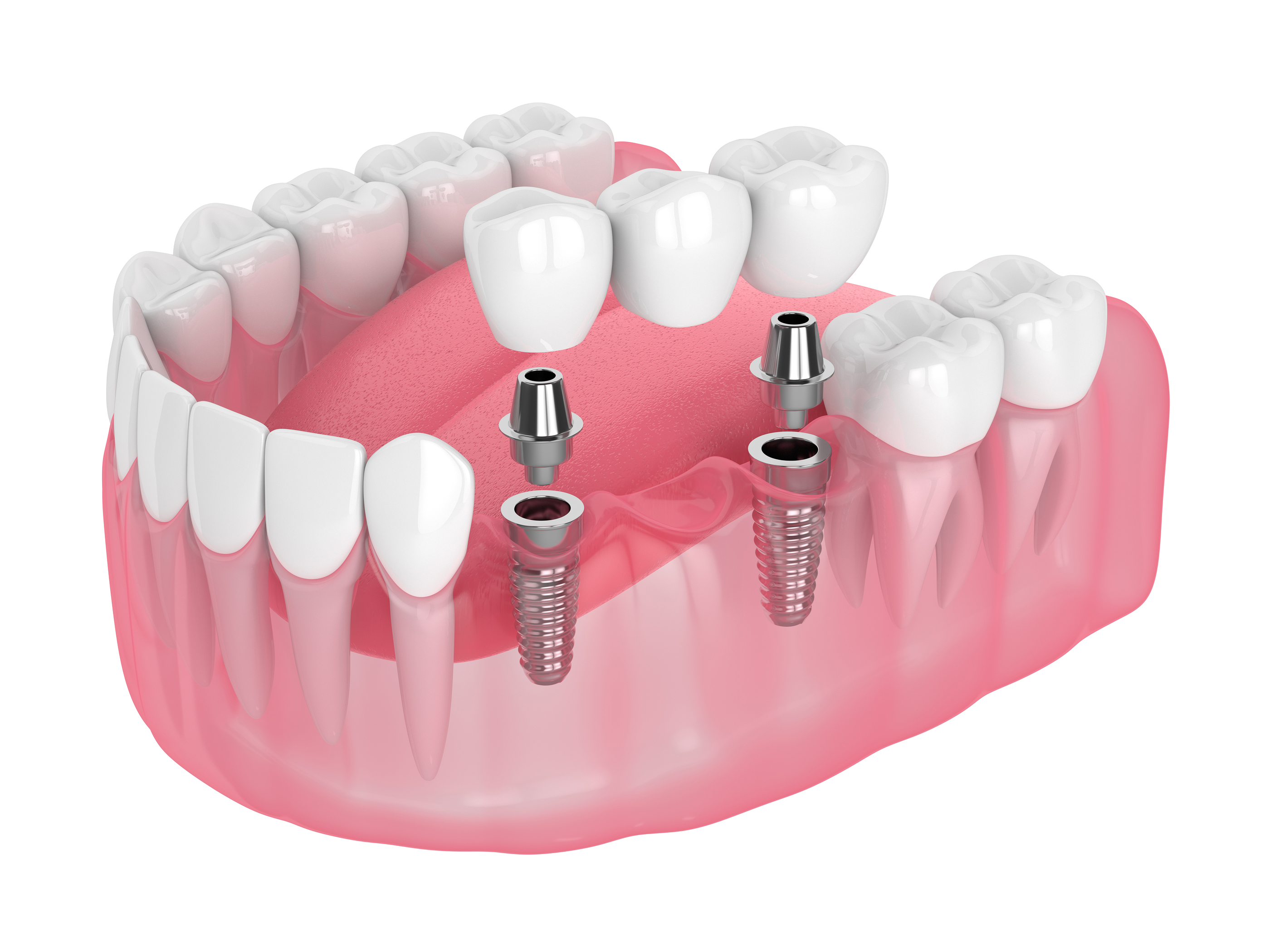 Dental Crown & Bridge