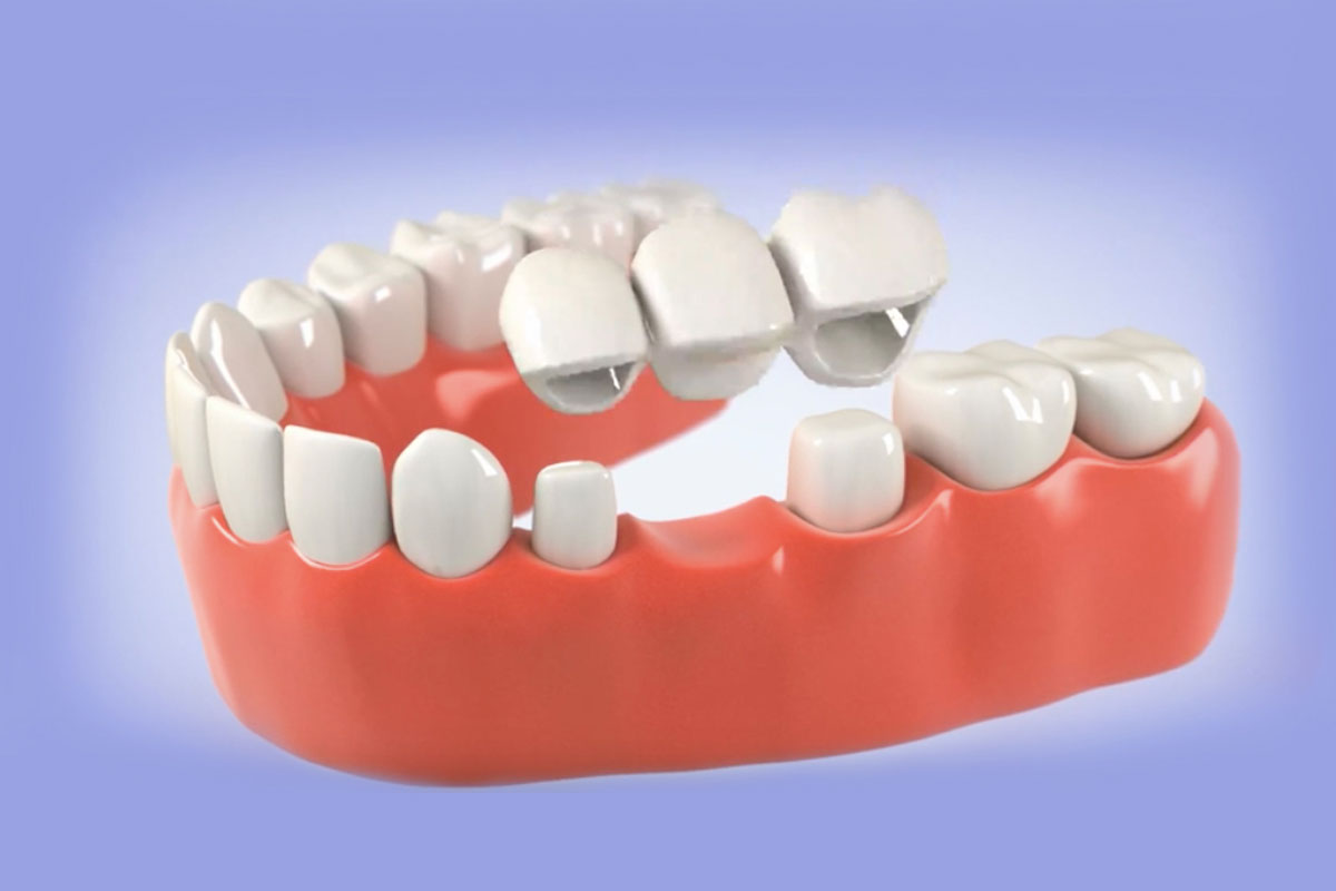 Dental Crown & Bridge