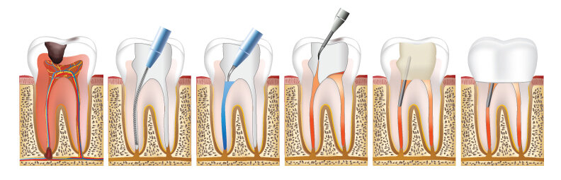 Root Canal Treatment