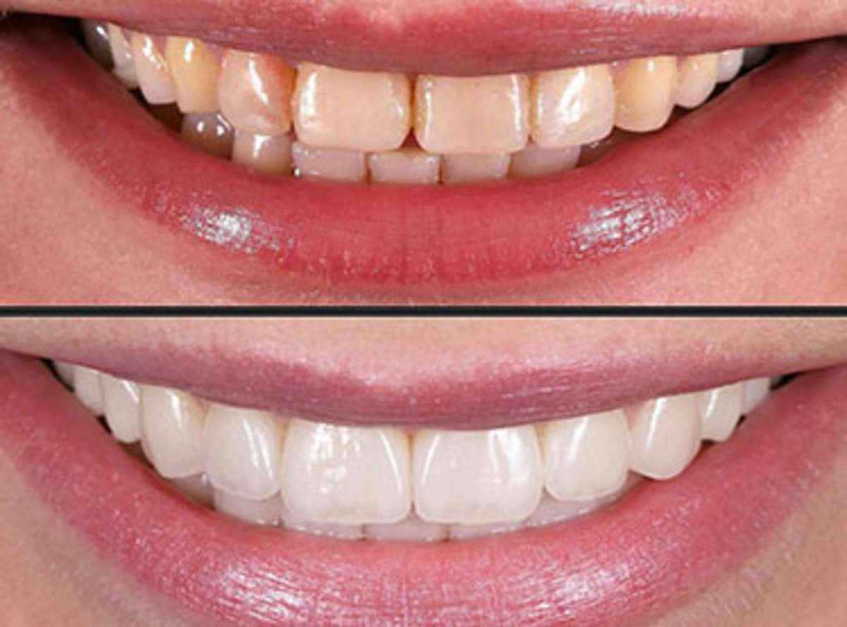 Dental Veneers Treatment