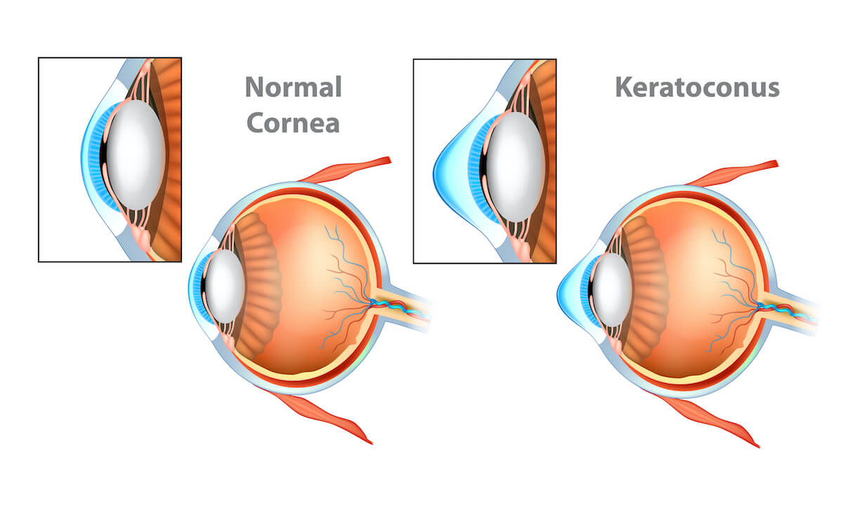 Cornea