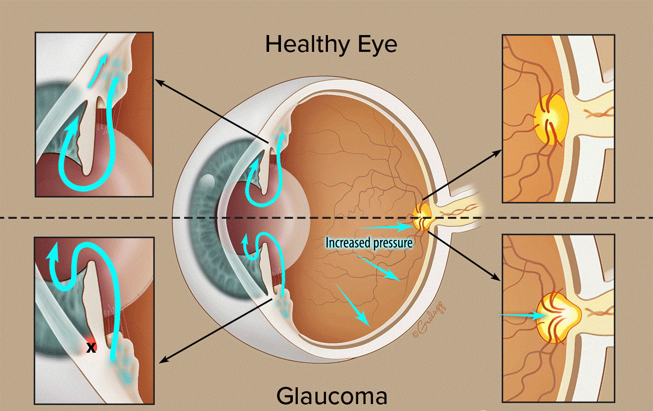 Glaucoma