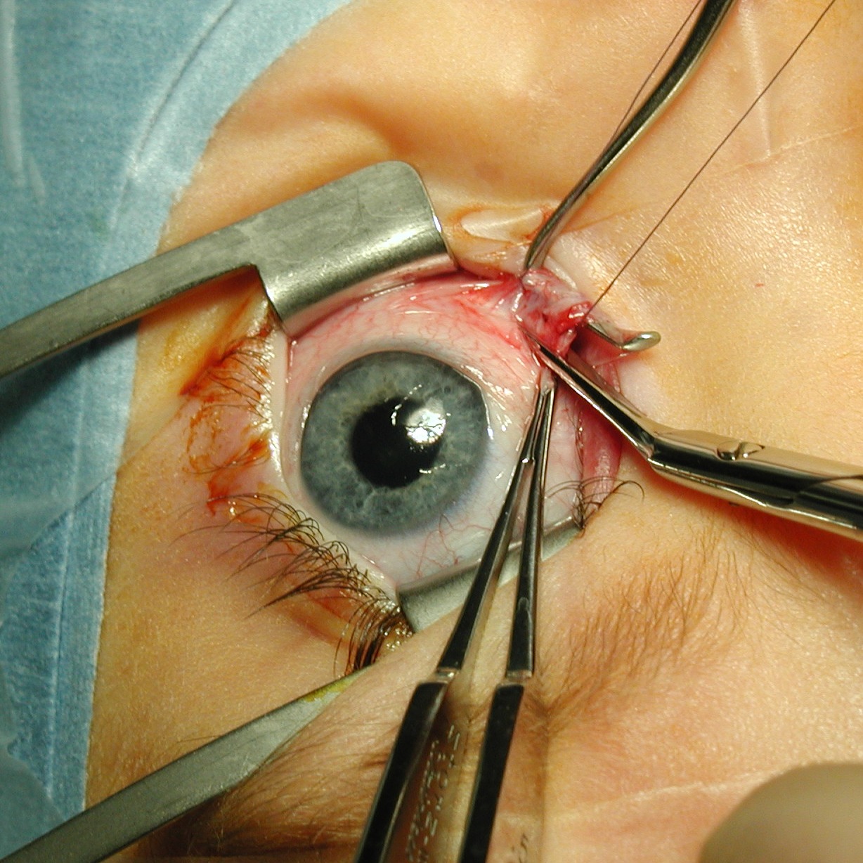 Oculoplasty