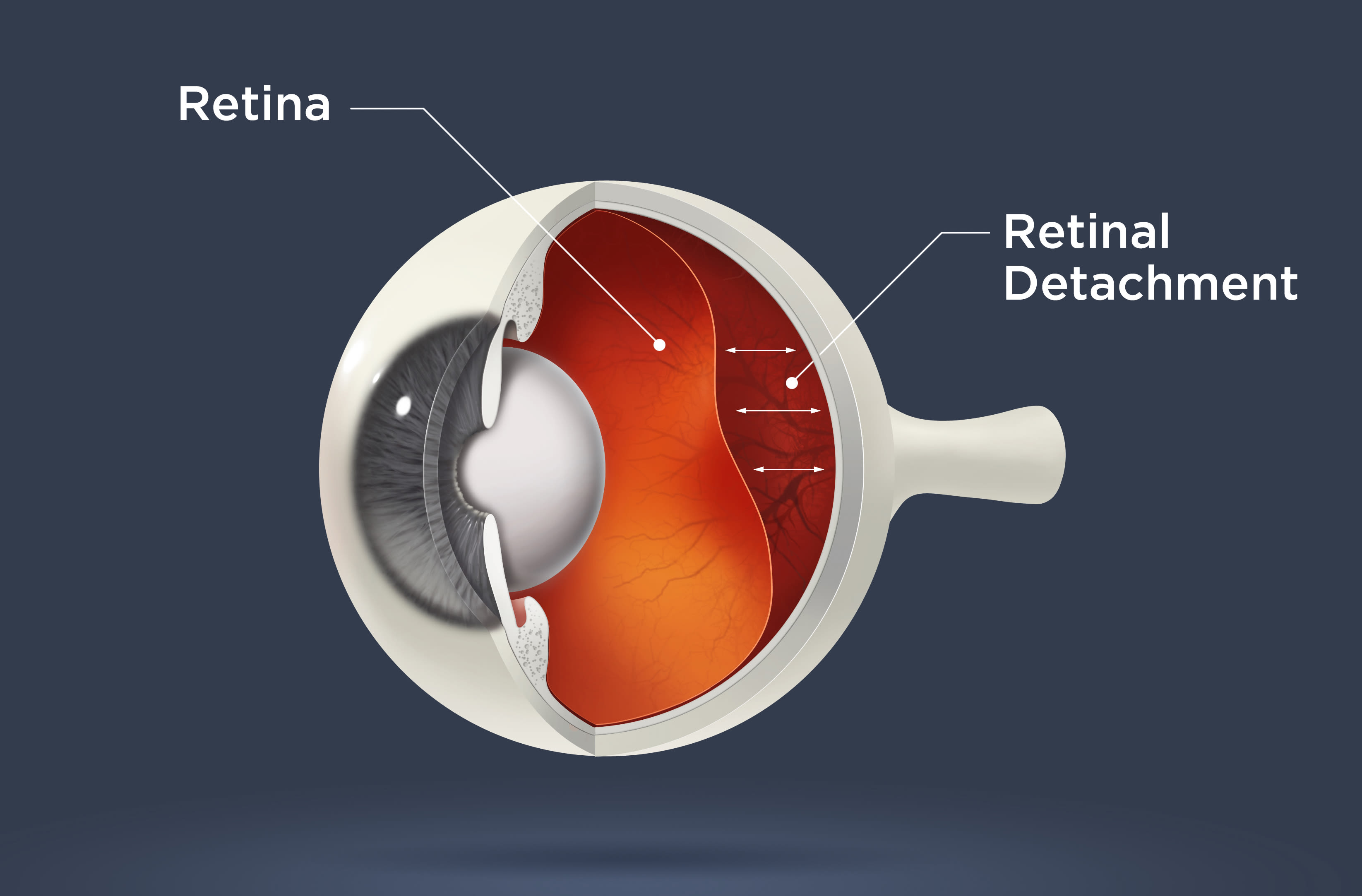 Retinal Surgery