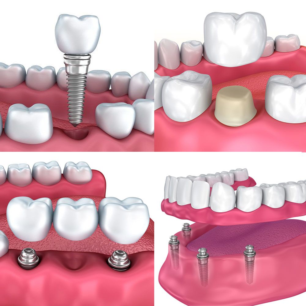 Full Mouth Rehabilitation