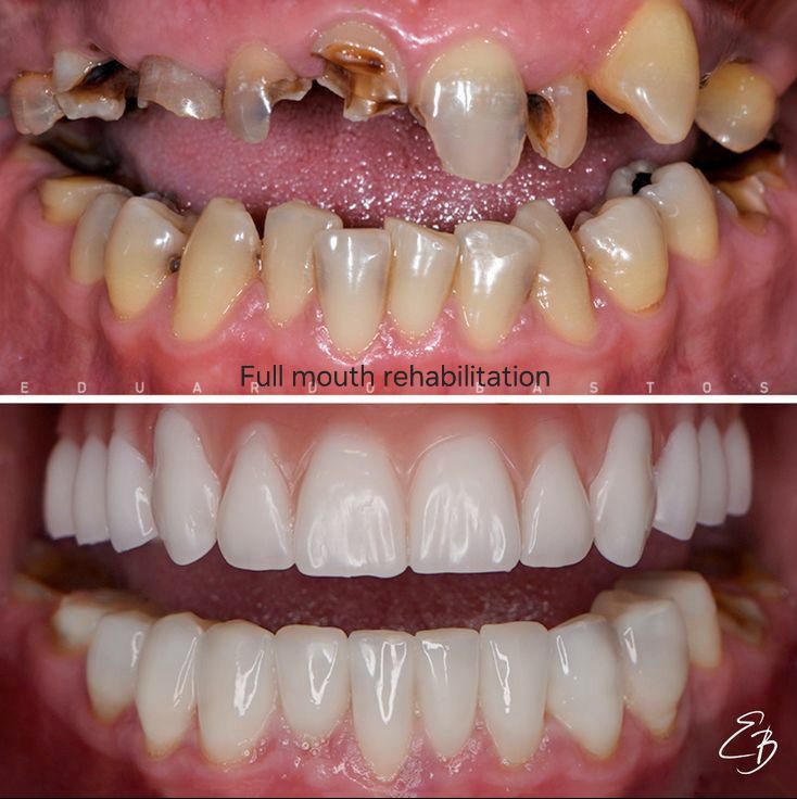 Full Mouth Rehabilitation