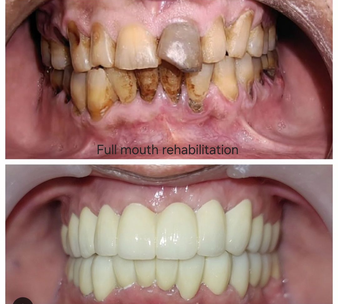 Full Mouth Rehabilitation